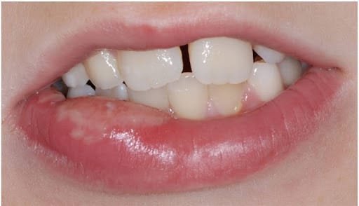 Child with a numb lip after a dental procedure