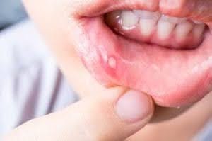 Example of a canker sore in a child's mouth