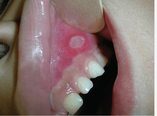 Example of a canker sore in a child's mouth